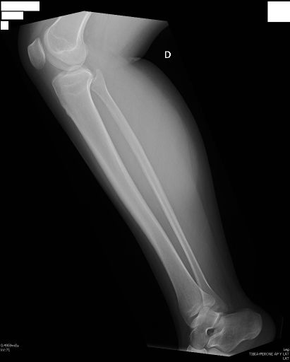 Lateral Leg Positioning